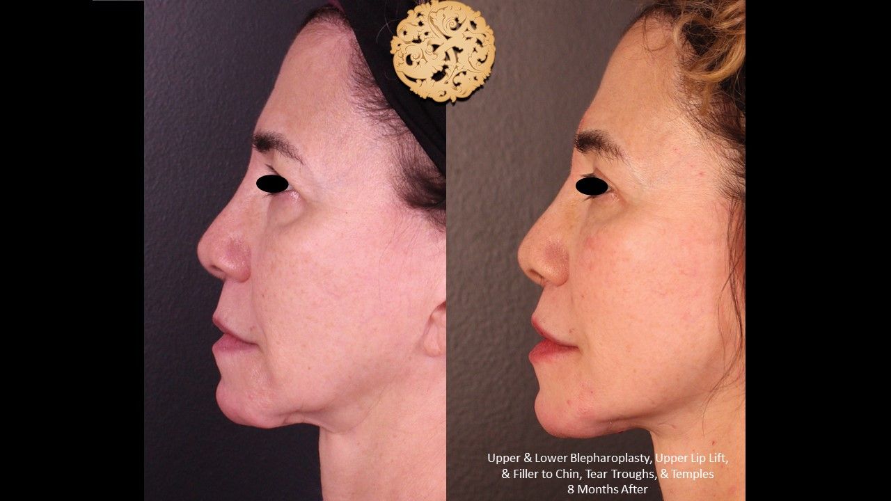 Lower Blepharoplasty Before & After