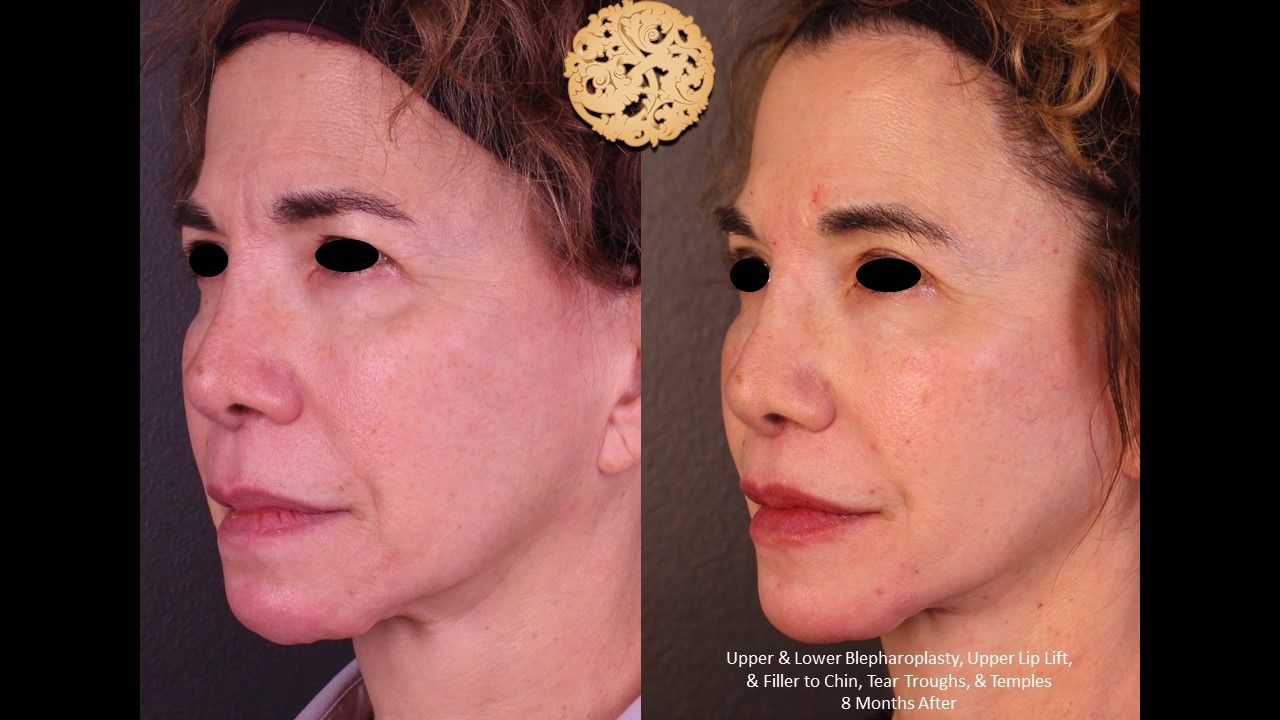 Lower Blepharoplasty Before & After