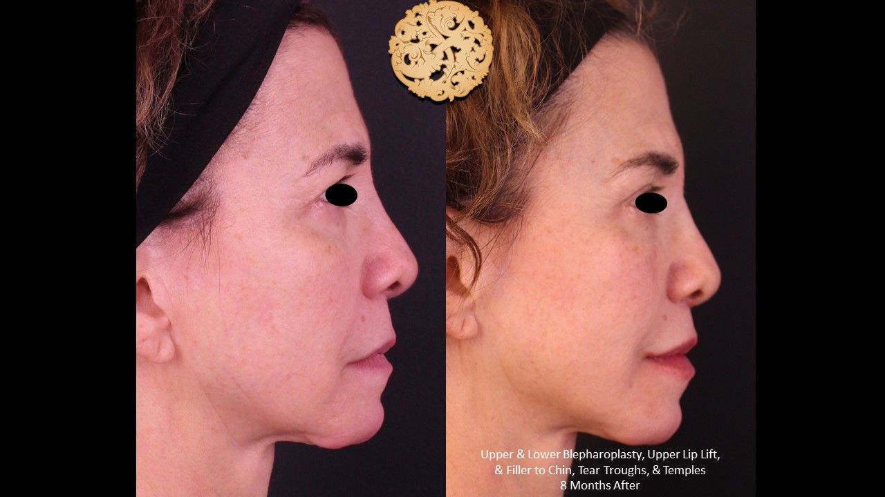 Lower Blepharoplasty Before & After