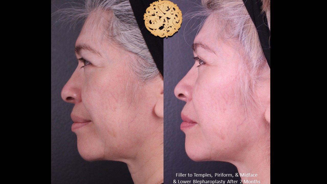 Lower Blepharoplasty Before & After