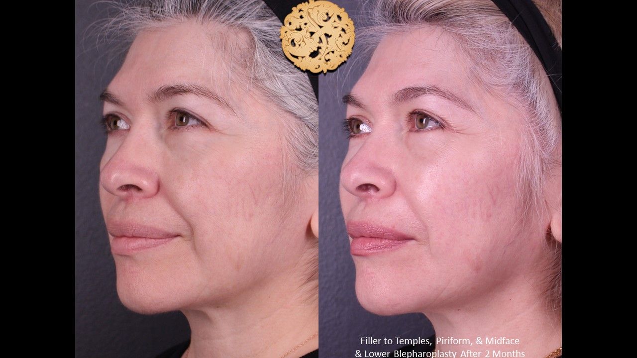 Lower Blepharoplasty Before & After
