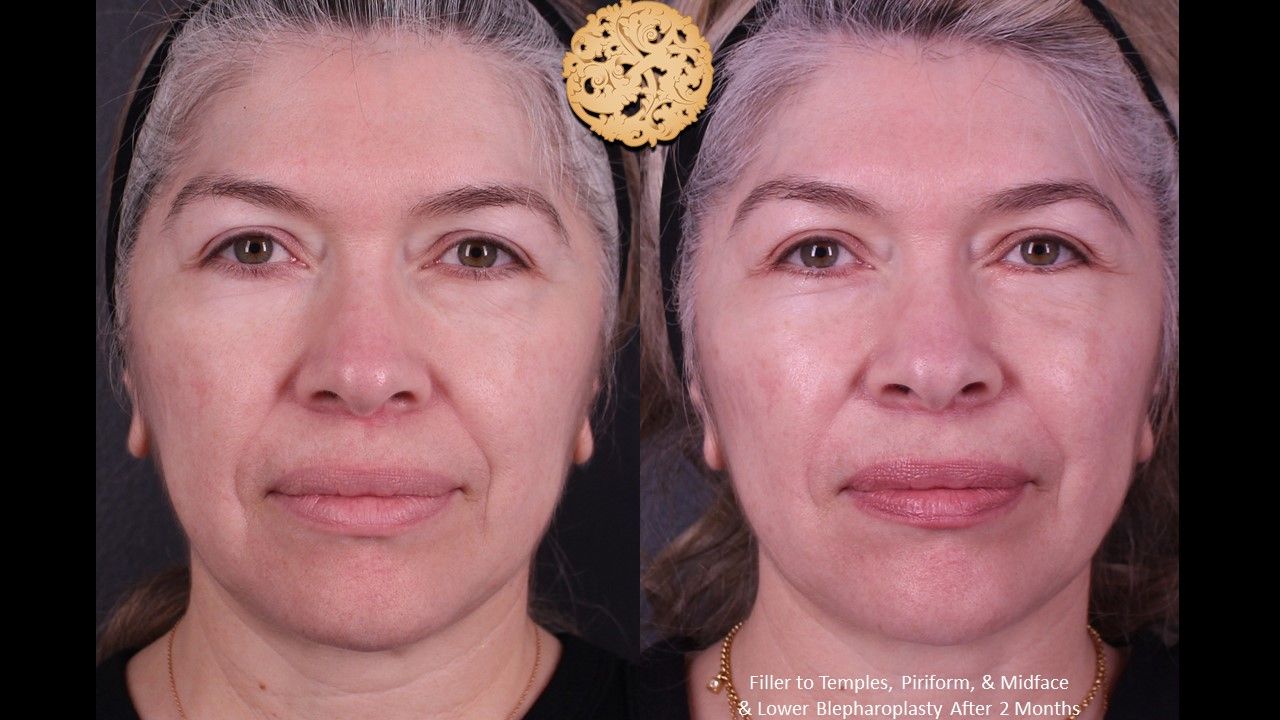 Lower Blepharoplasty Before & After