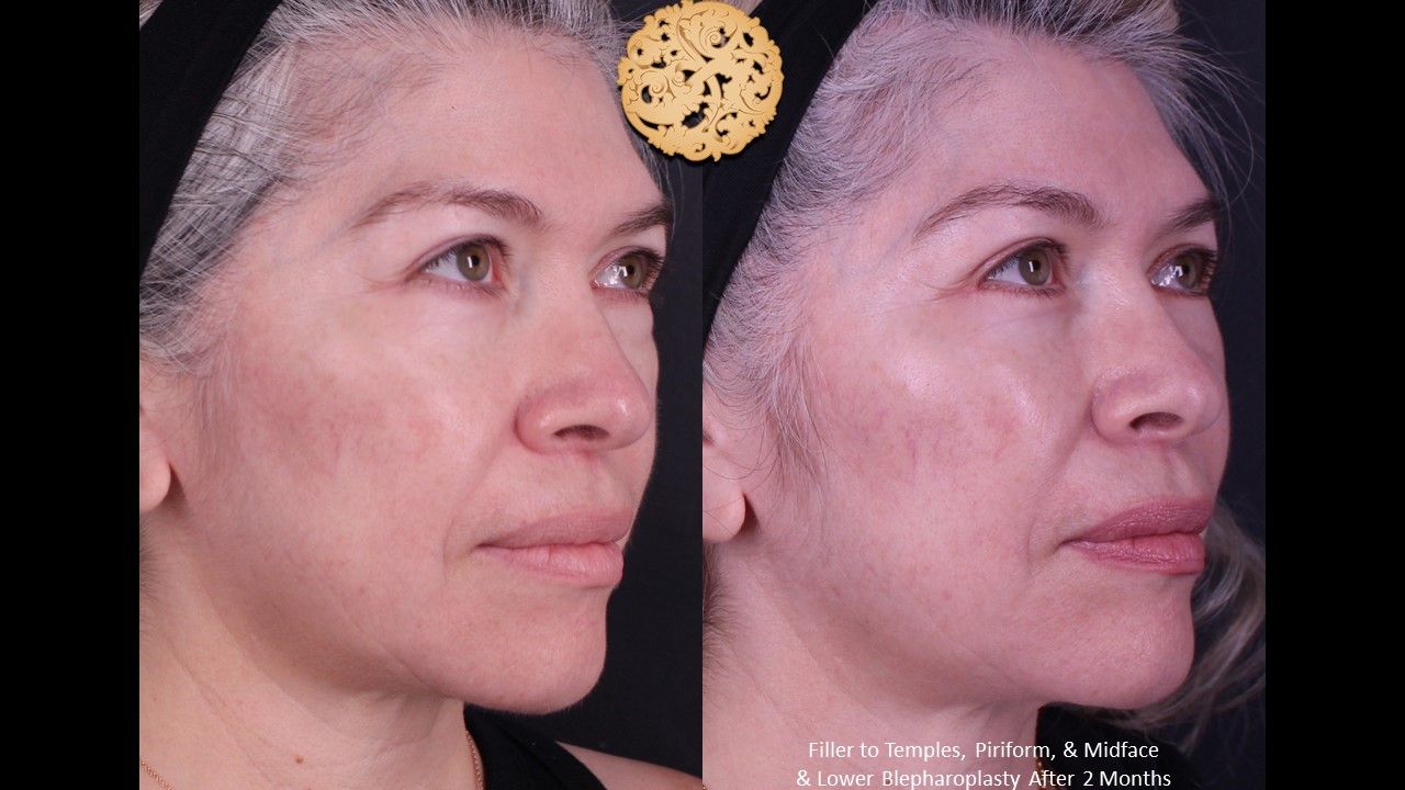 Lower Blepharoplasty Before & After