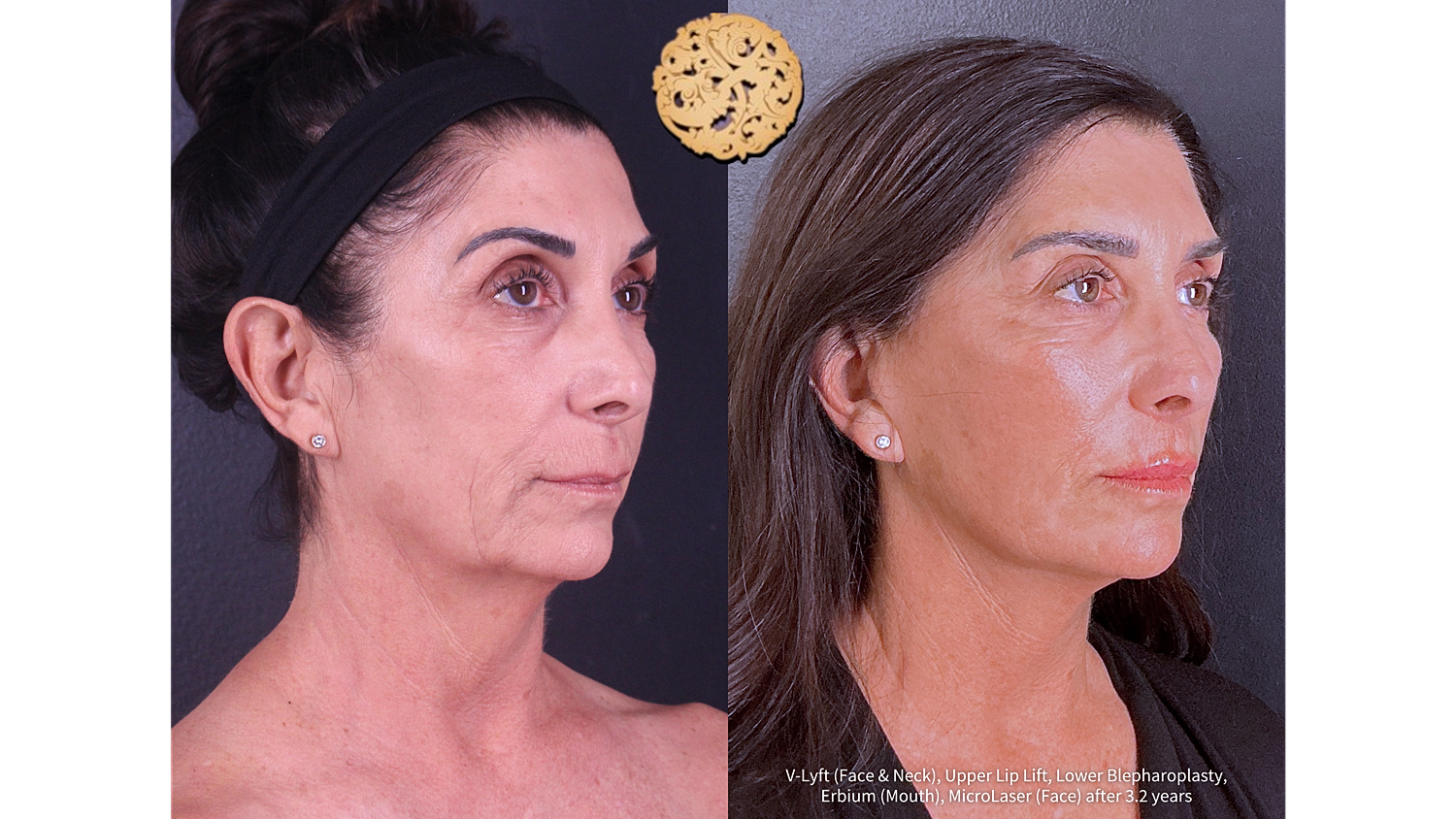 Lower Blepharoplasty Before and After