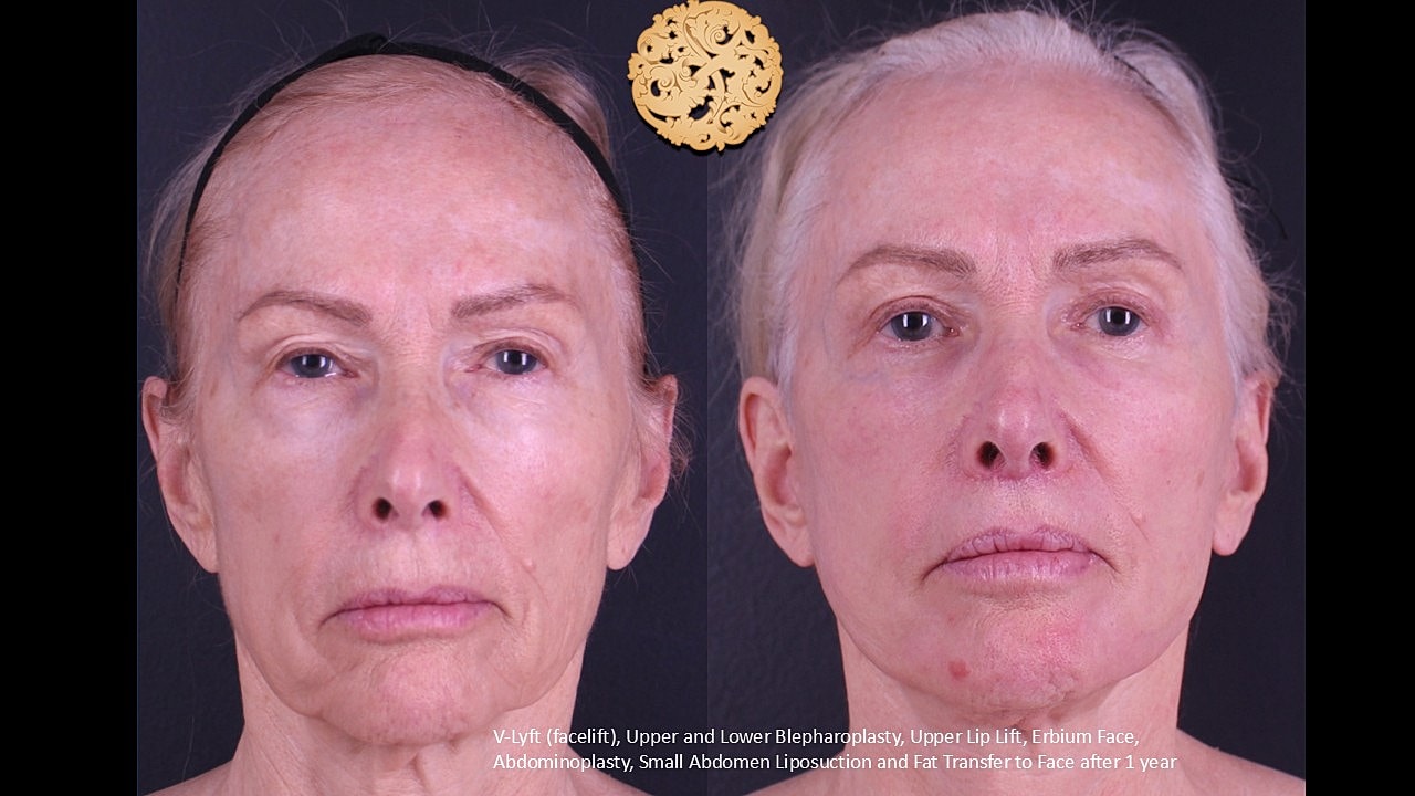 Lower Blepharoplasty Before & After