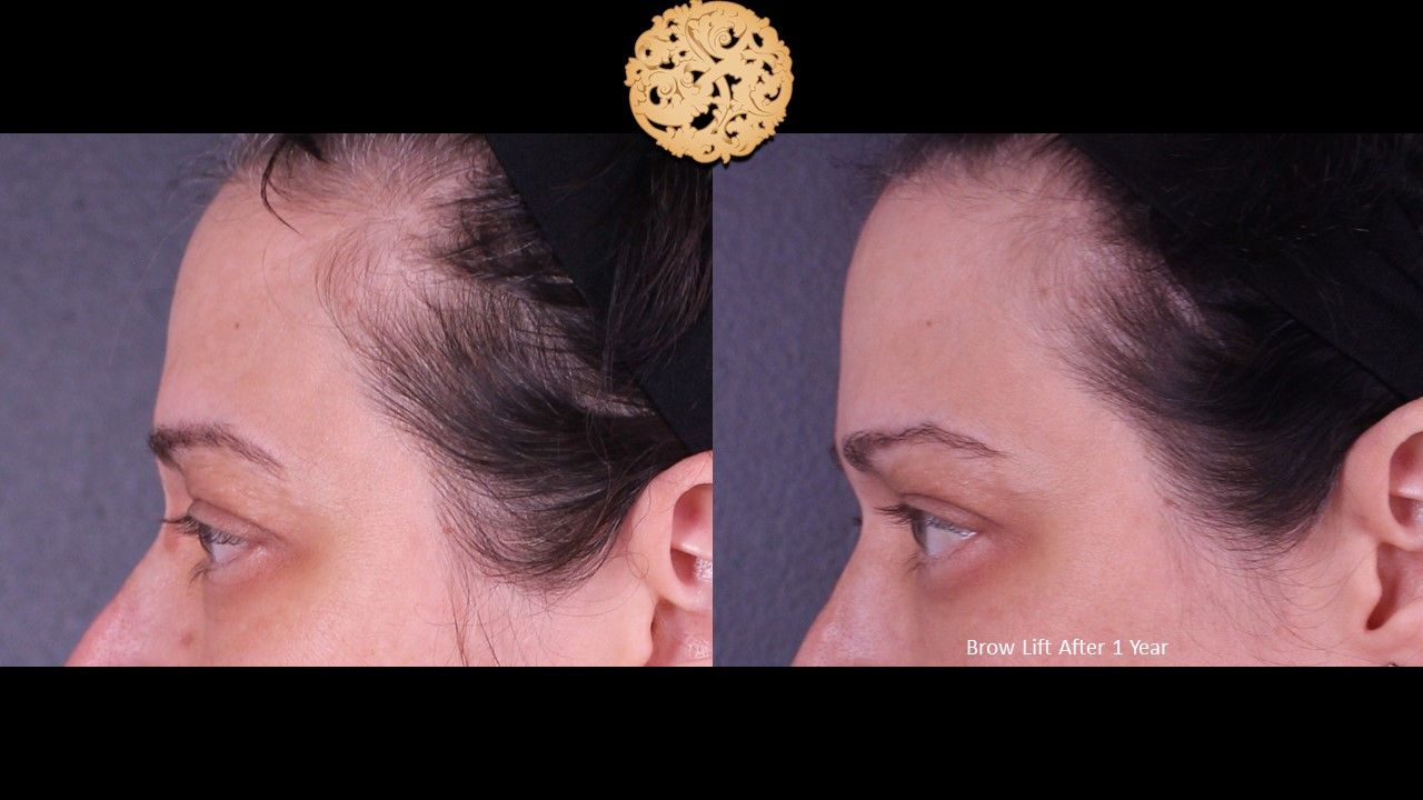 Brow Lift Before & After