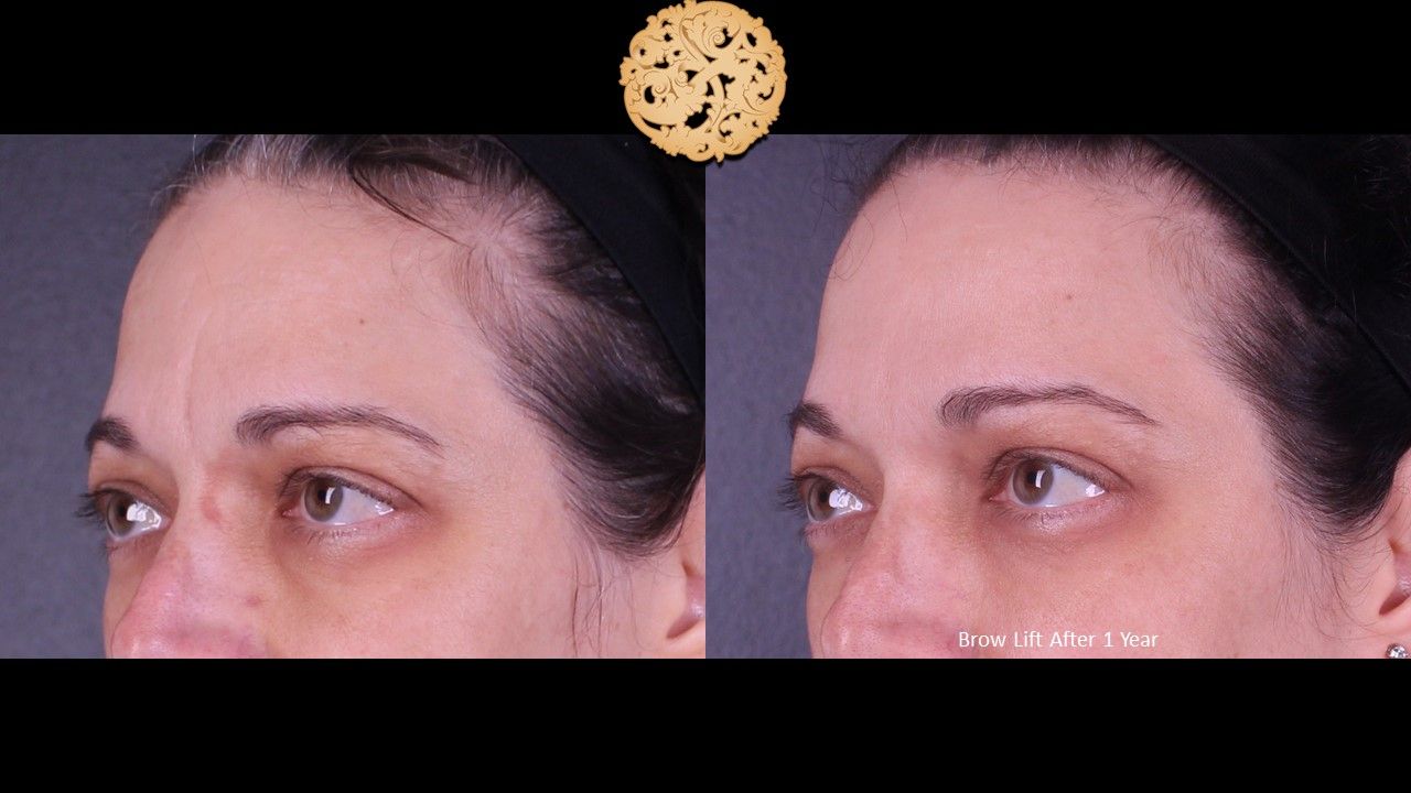 Brow Lift Before & After