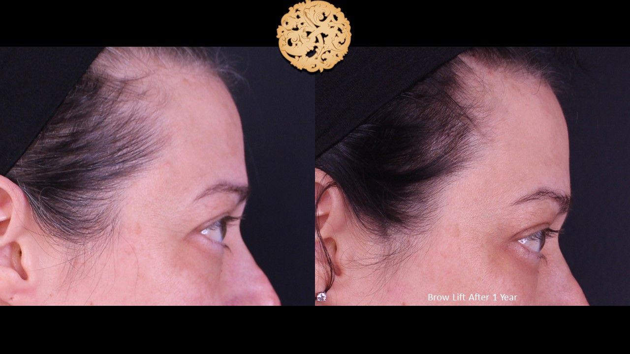 Brow Lift Before & After