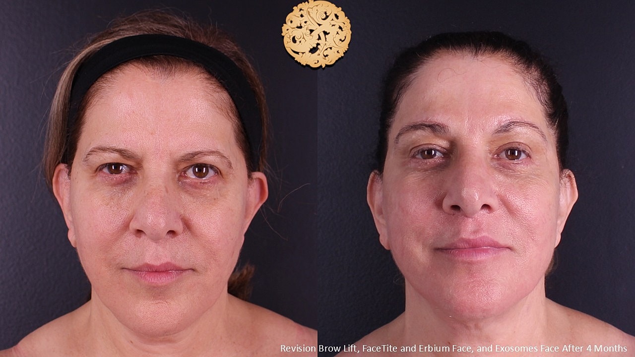 Brow Lift Before & After