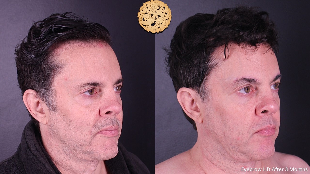 Brow Lift Before & After