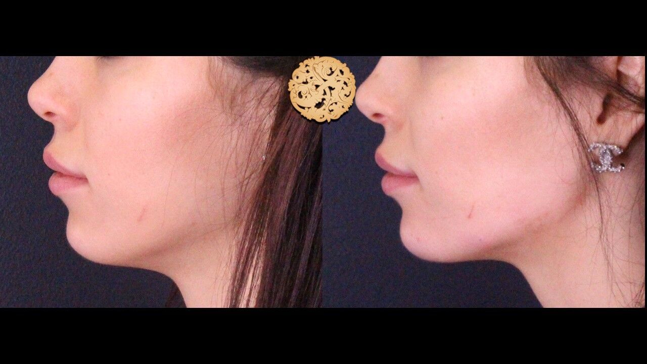 Jaw Filler Before & After