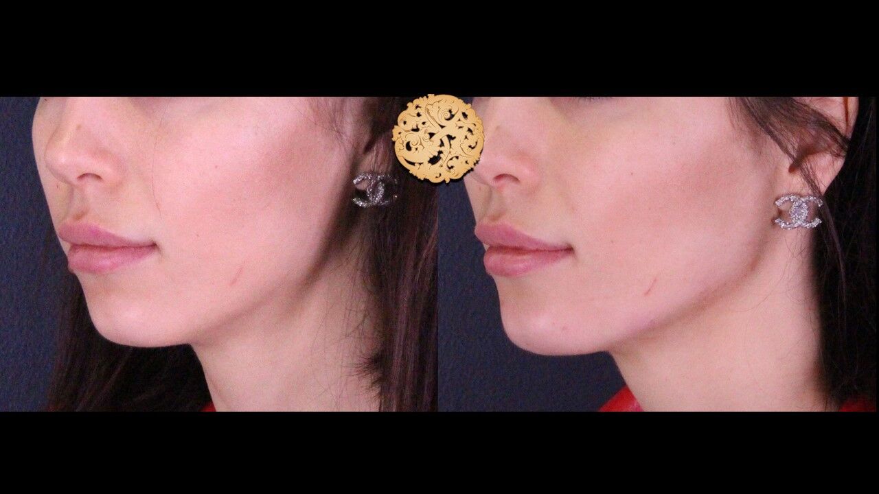 Jaw Filler Before & After