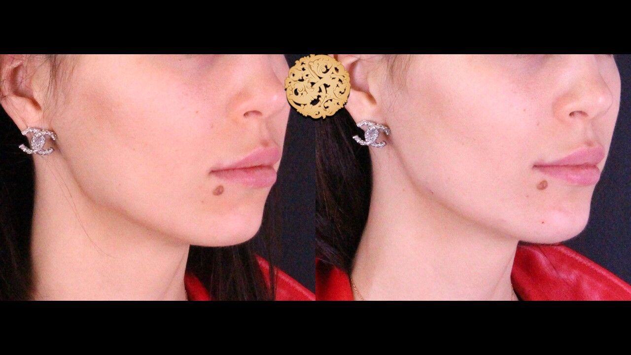 Jaw Filler Before & After