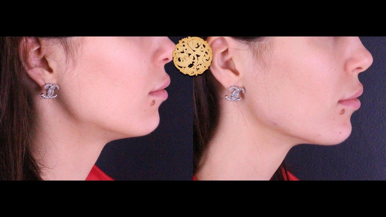 Jaw Filler Before & After