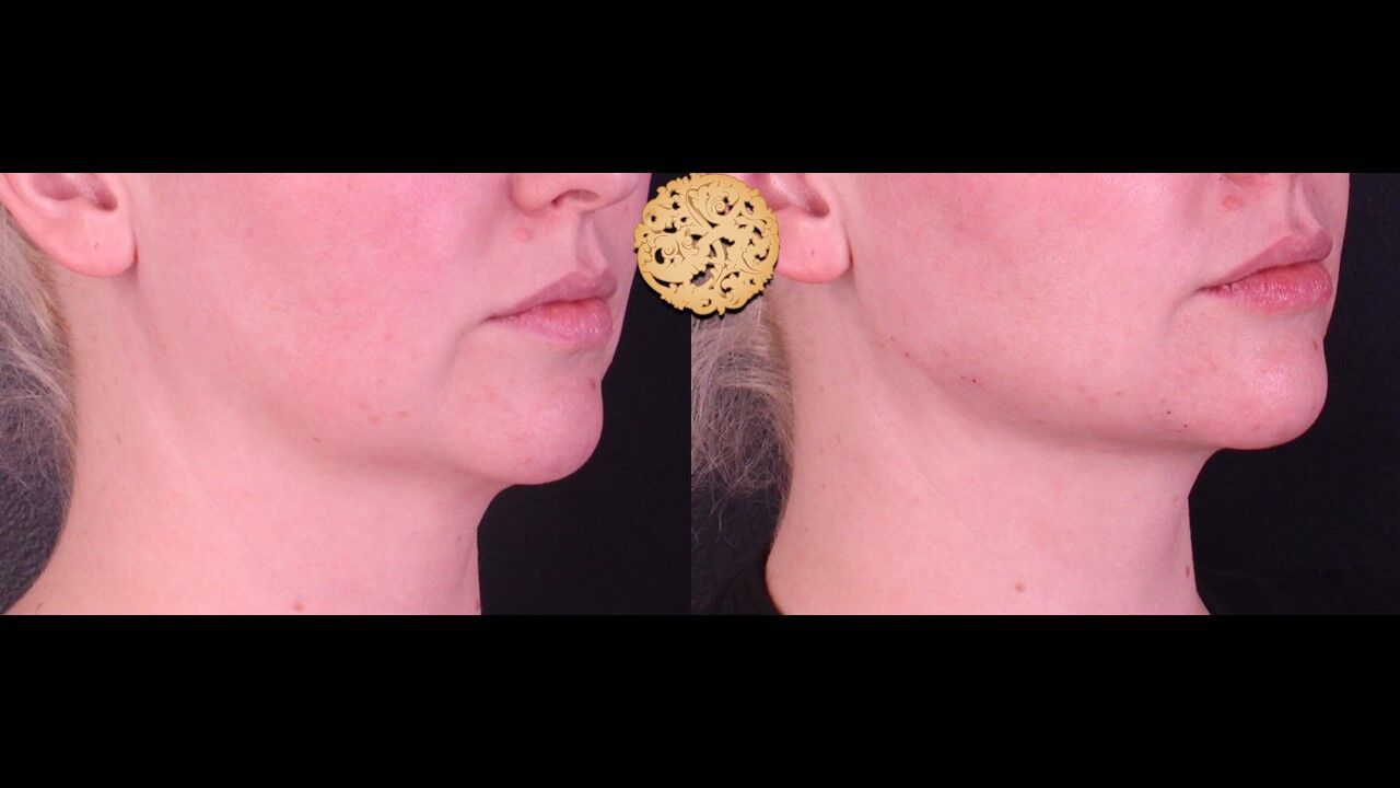 Jaw Filler Before & After