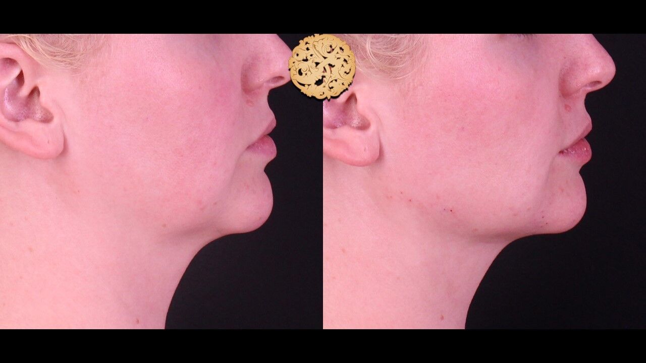 Jaw Filler Before & After