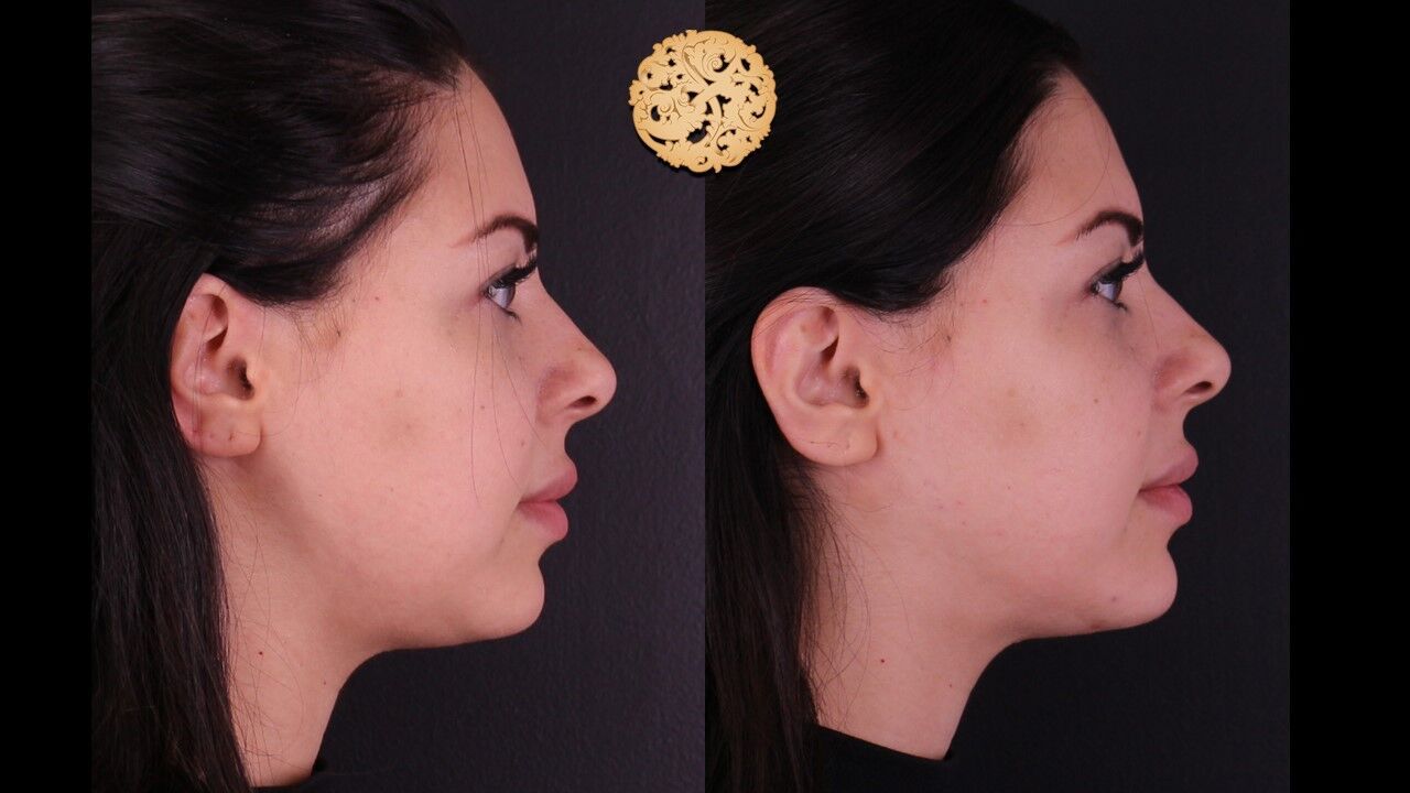 Jaw Filler Before & After