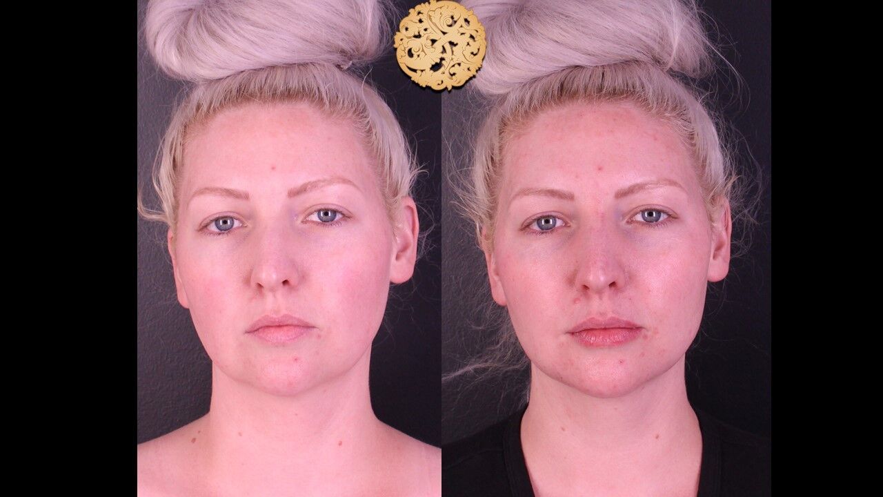 Jaw Filler Before & After