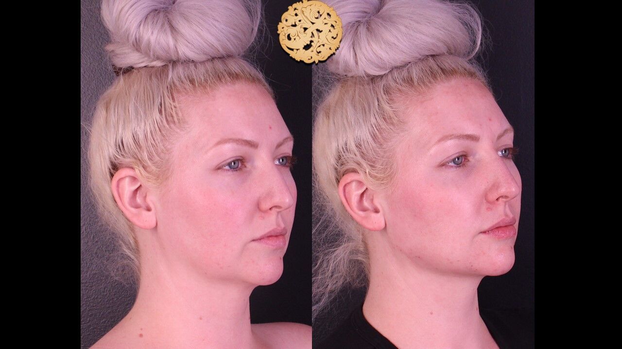 Jaw Filler Before & After