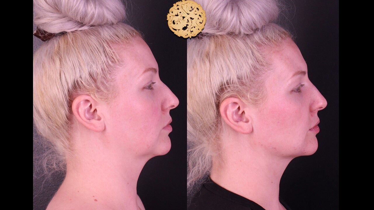 Jaw Filler Before & After