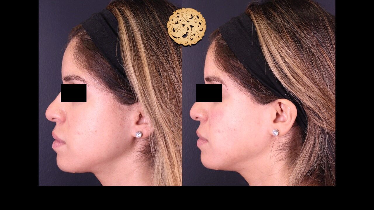 Jaw Filler Before & After