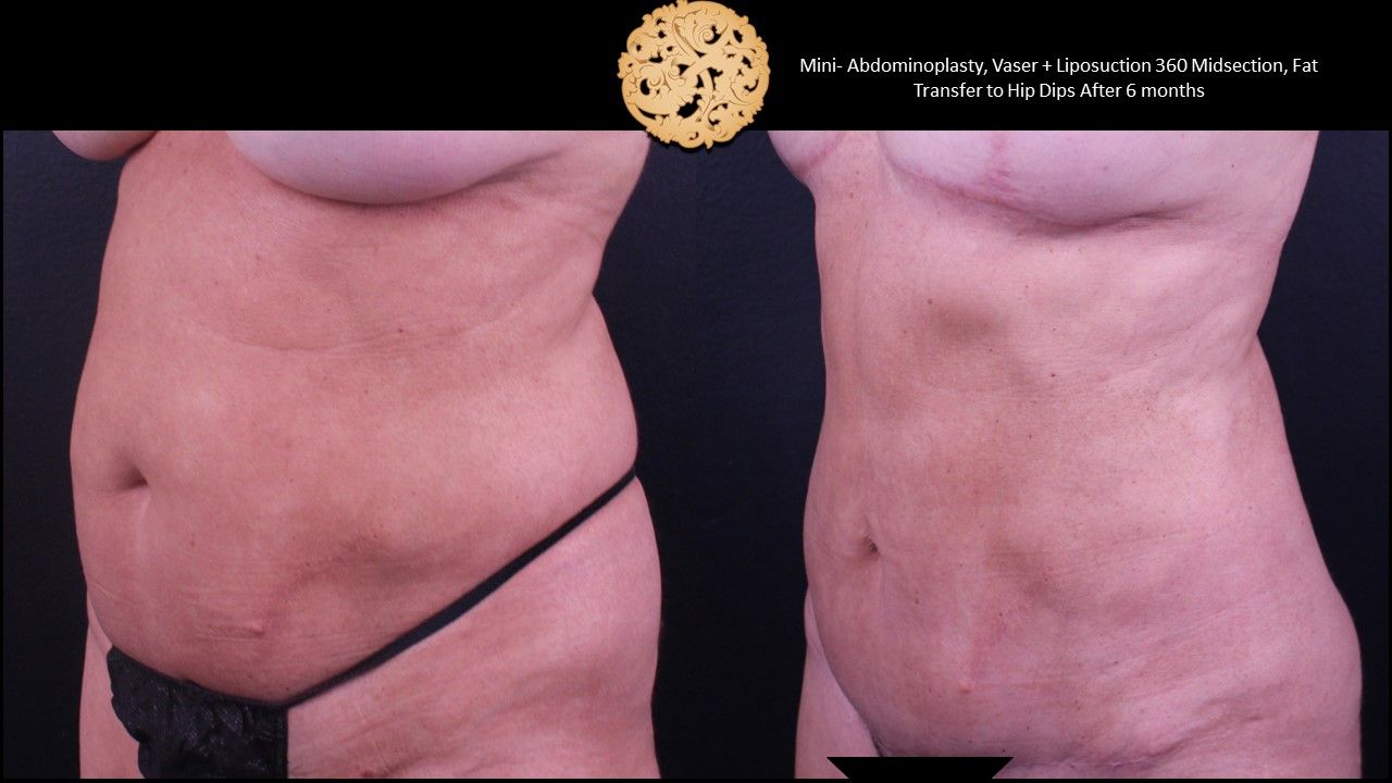 Mini Tummy Tuck Before & After
