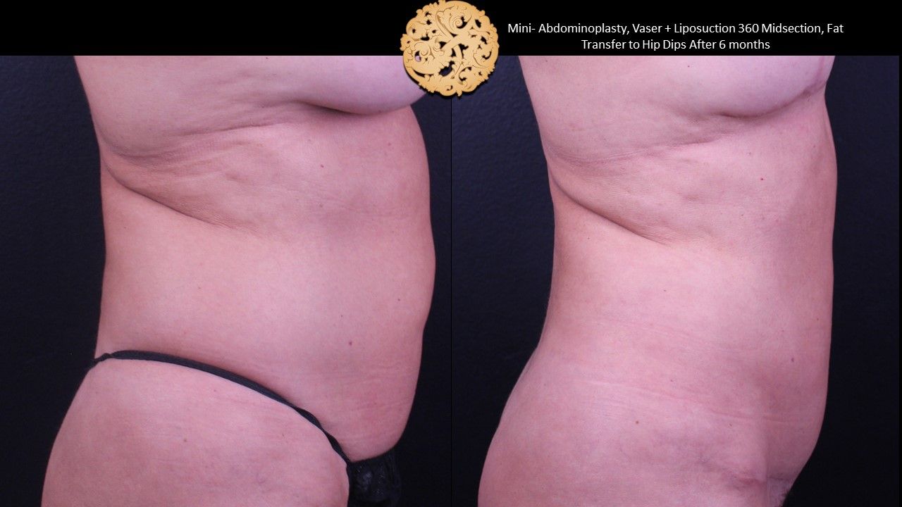 Mini Tummy Tuck Before & After