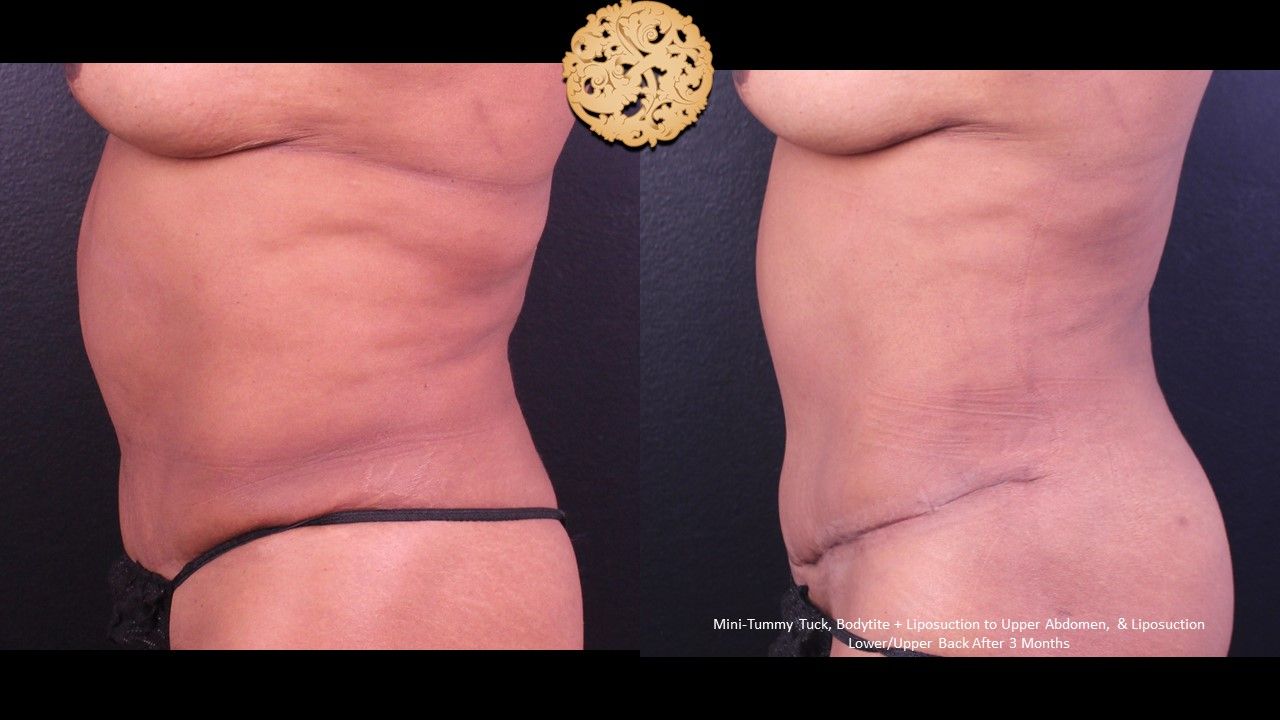 Mini Tummy Tuck Before & After