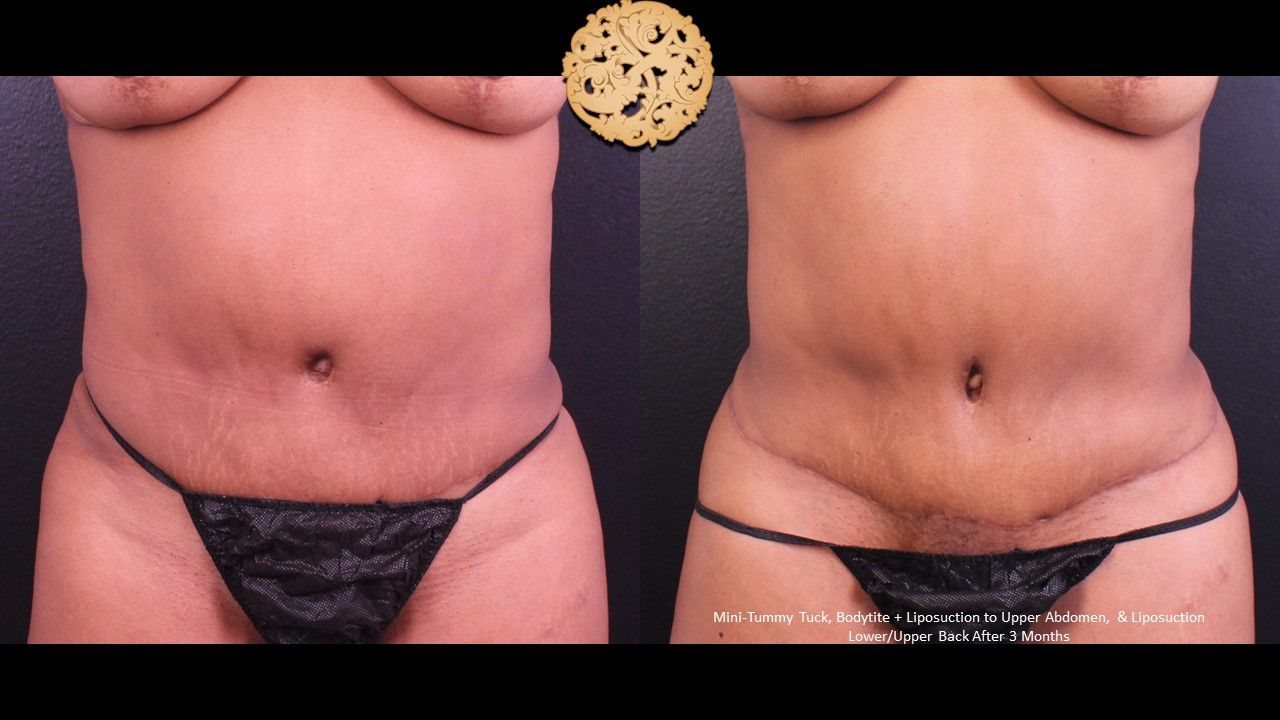 Mini Tummy Tuck Before & After