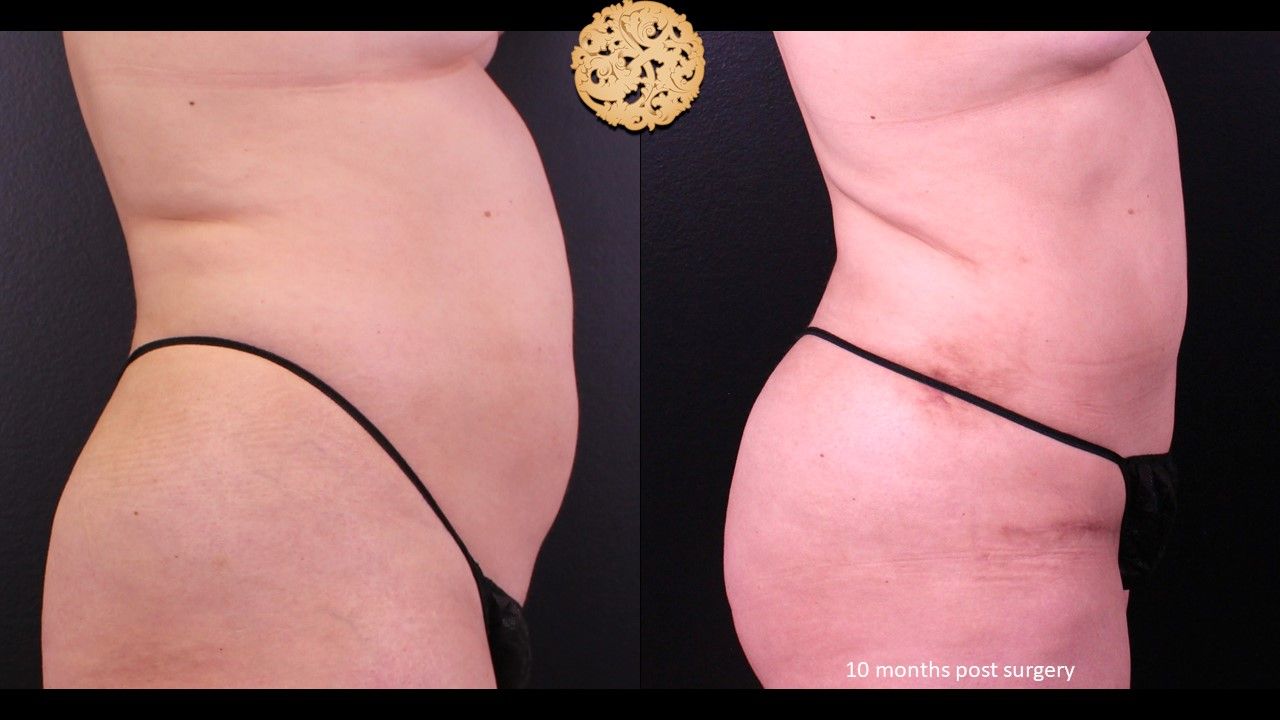 Mini Tummy Tuck Before & After