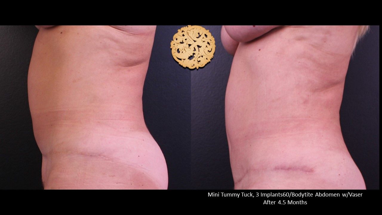 Mini Tummy Tuck Before & After