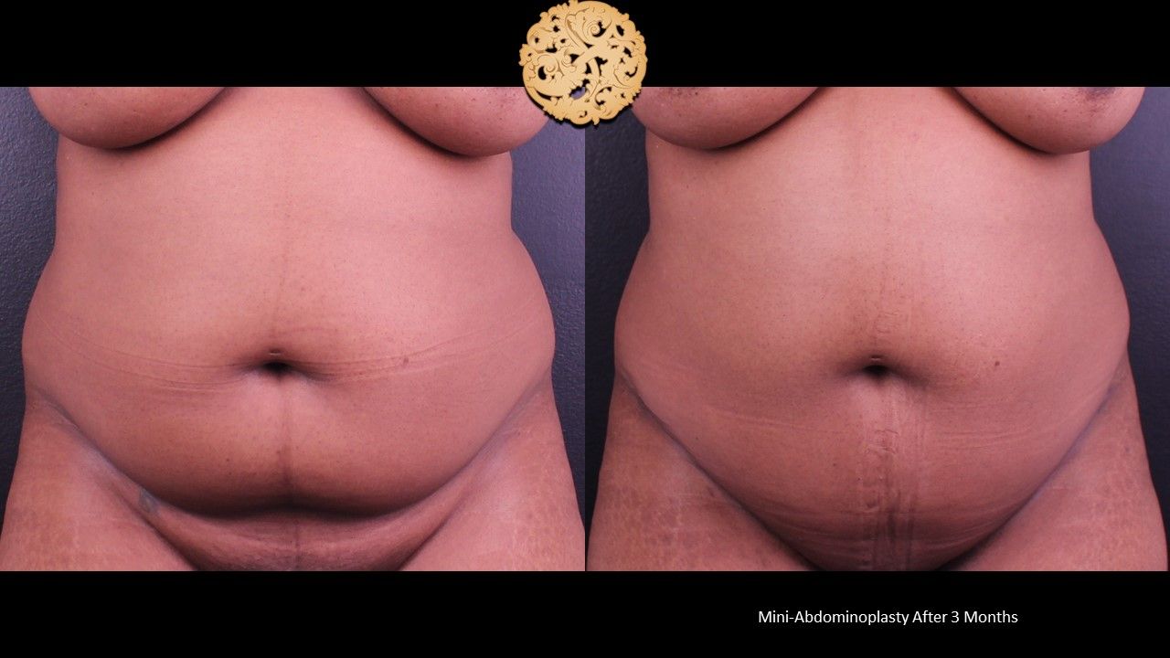 Mini Tummy Tuck Before & After