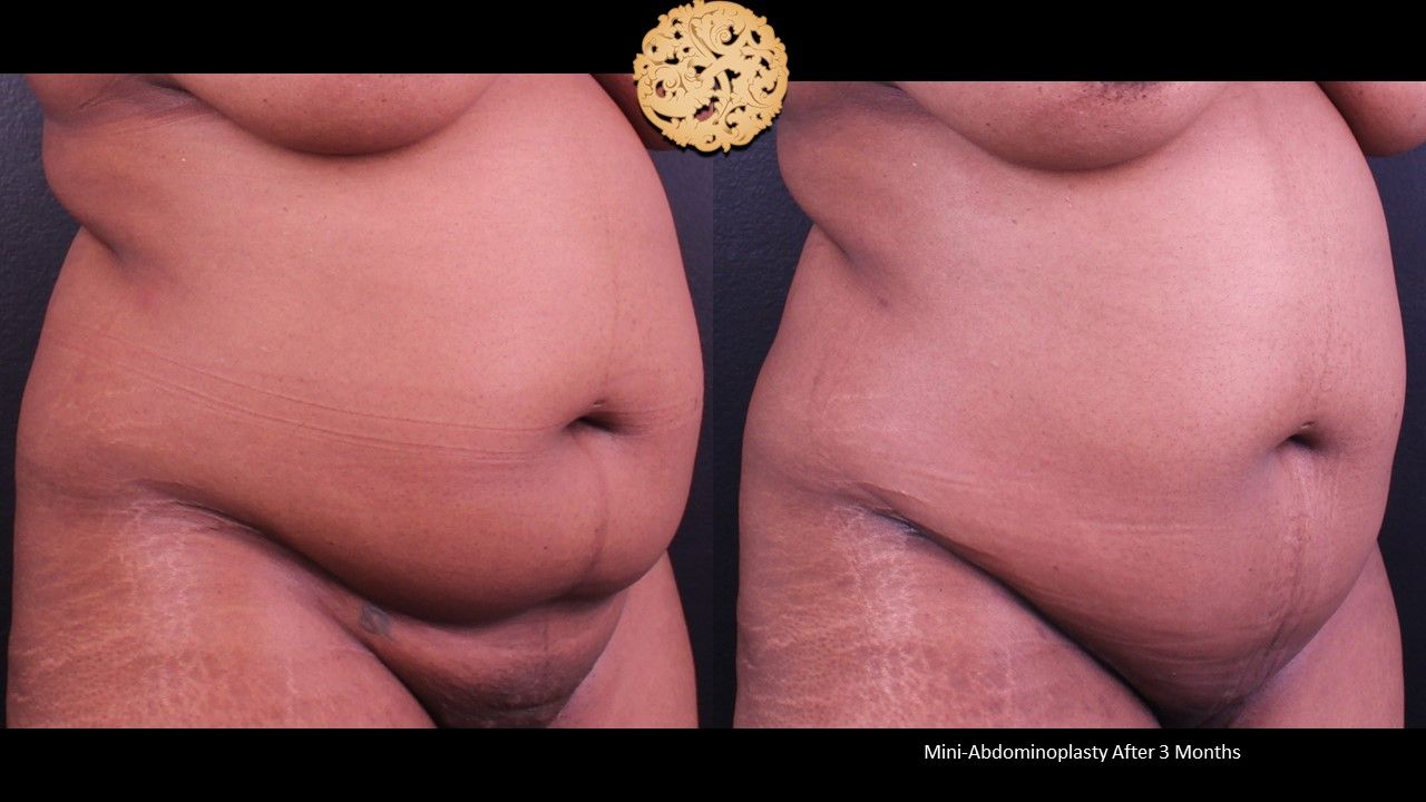 Mini Tummy Tuck Before & After