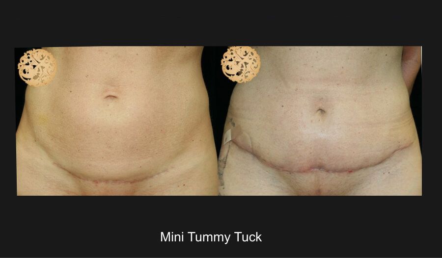 Mini Tummy Tuck Before & After