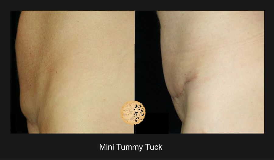 Mini Tummy Tuck Before & After