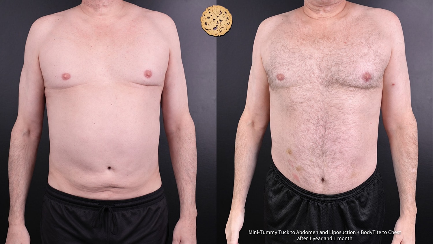 Mini Tummy Tuck Before & After