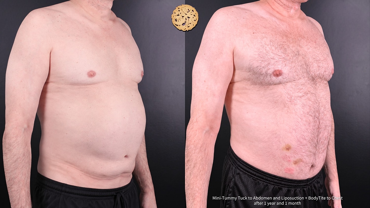 Mini Tummy Tuck Before & After