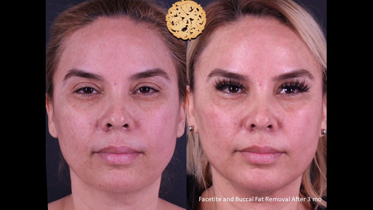 Buccal Fat Removal Before & After