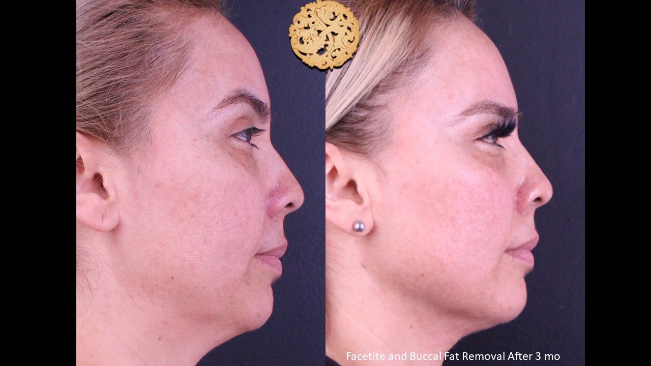 Buccal Fat Removal Before & After
