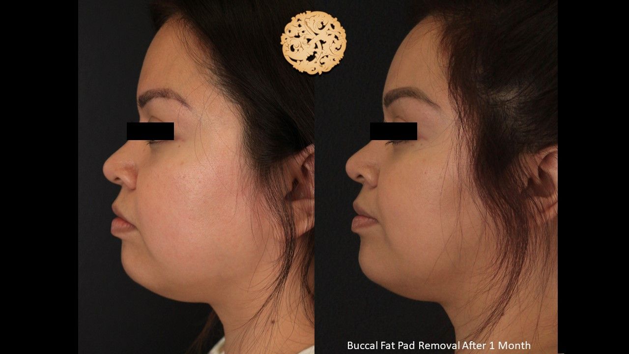 Buccal Fat Removal Before & After