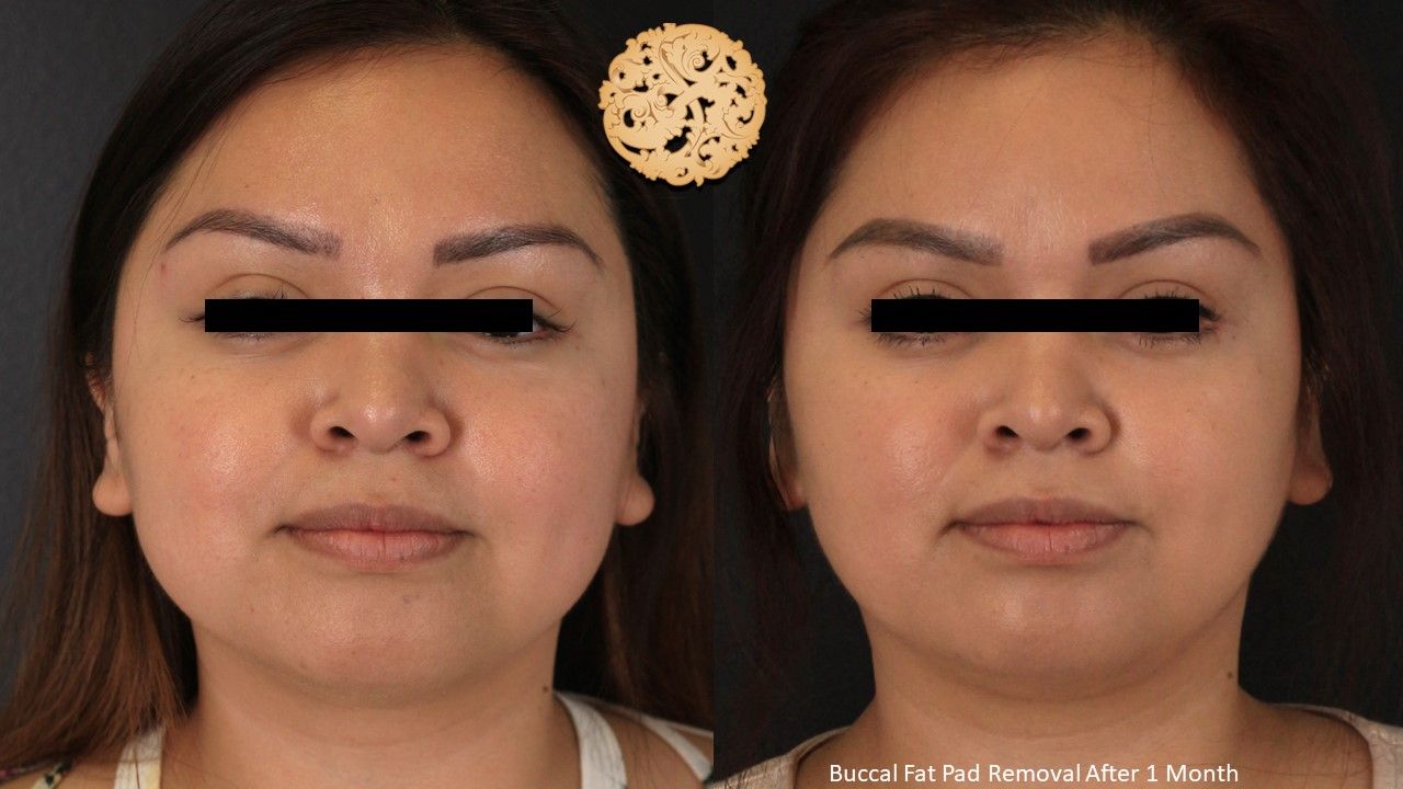 Buccal Fat Removal Before & After