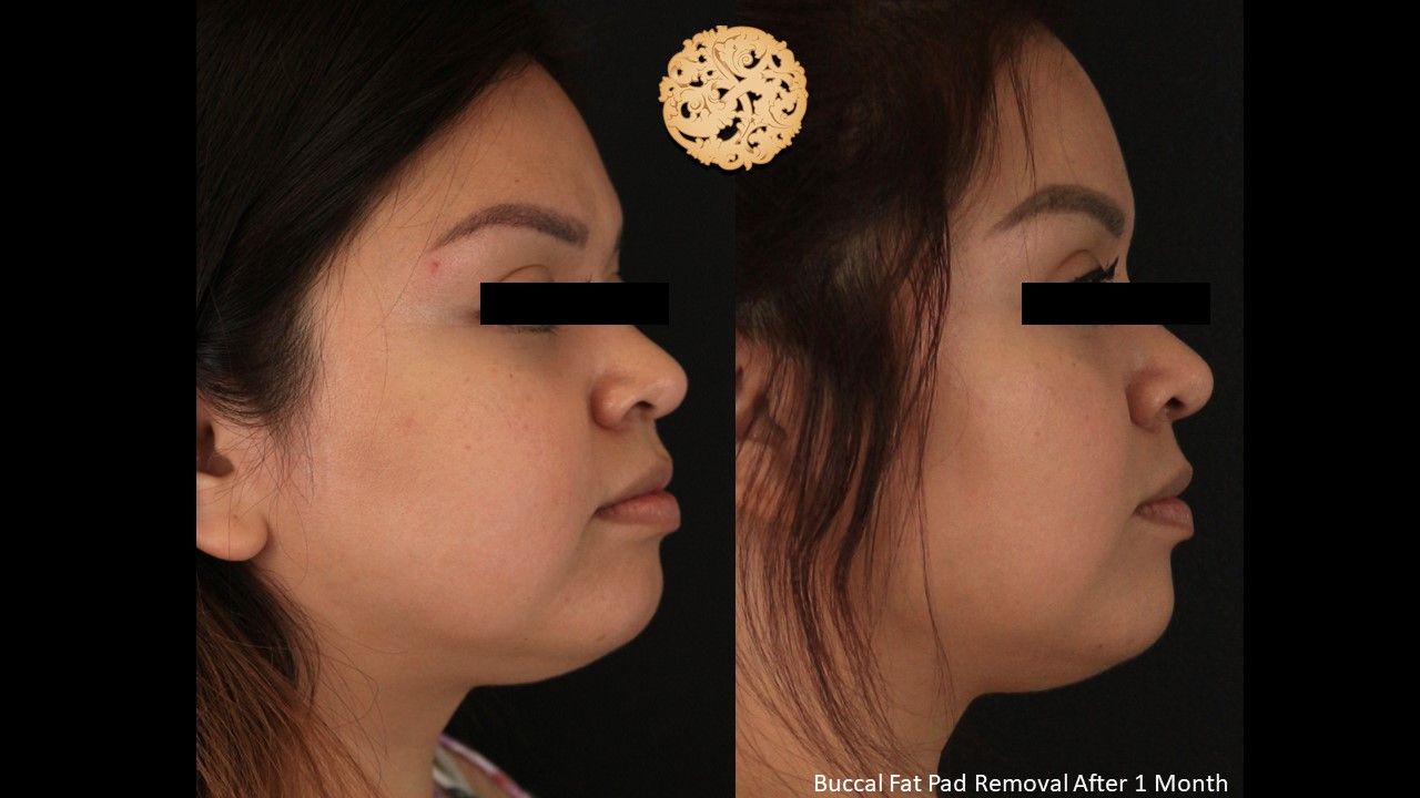 Buccal Fat Removal Before & After