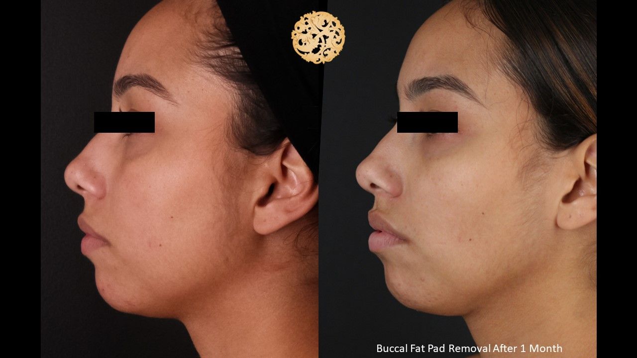 Buccal Fat Removal Before & After
