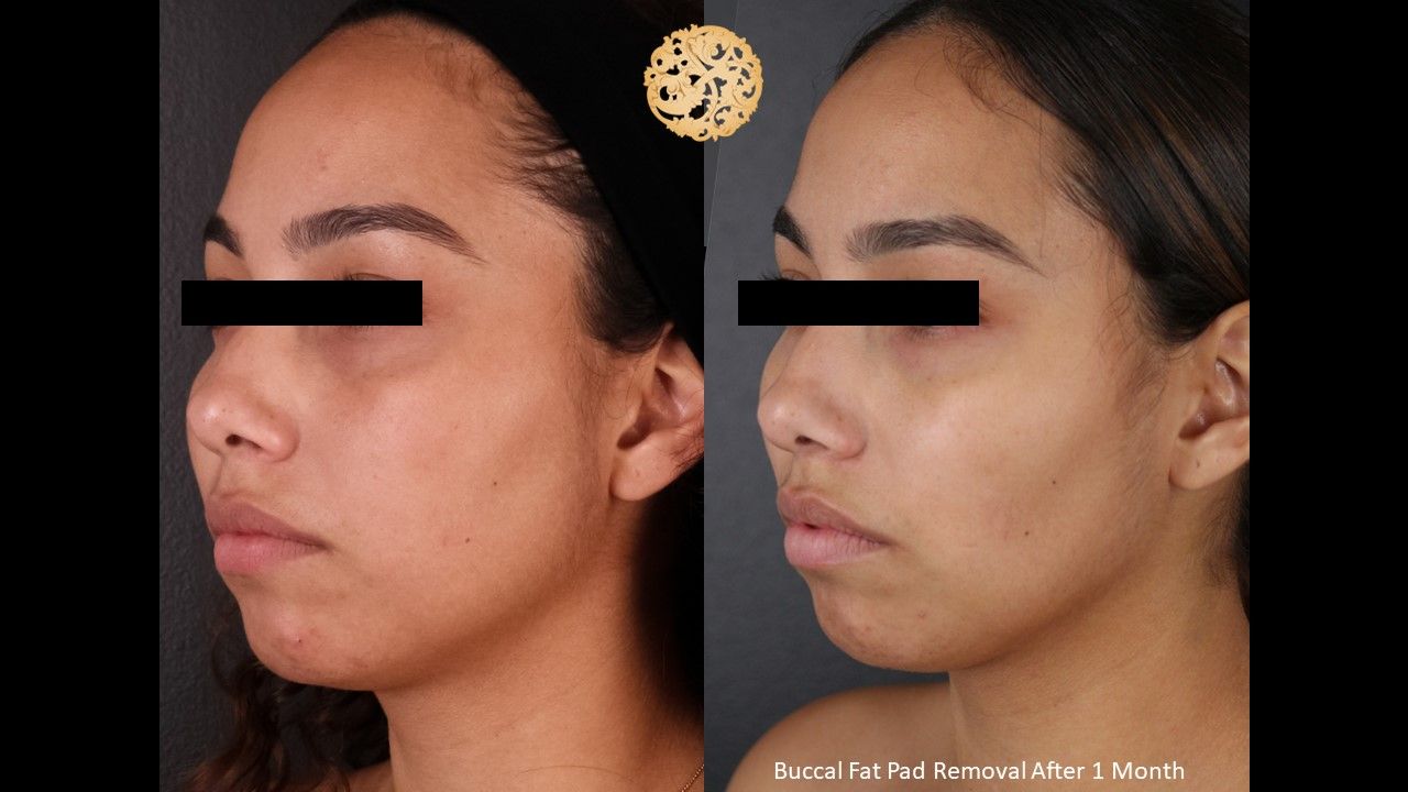 Buccal Fat Removal Before & After