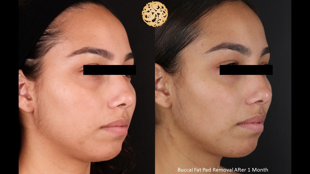 Buccal Fat Removal Before & After