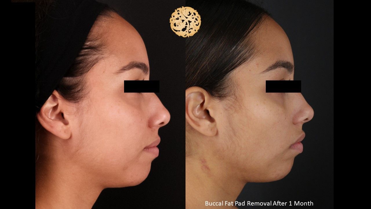 Buccal Fat Removal Before & After
