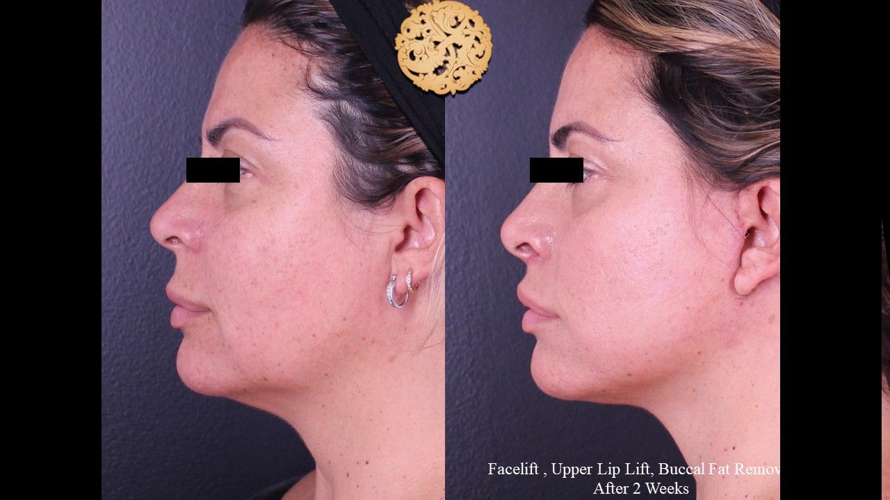 Buccal Fat Removal Before & After