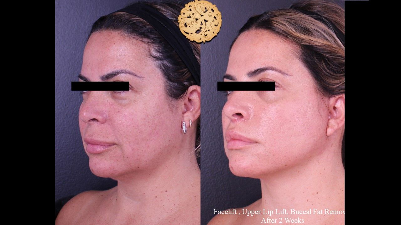 Buccal Fat Removal Before & After