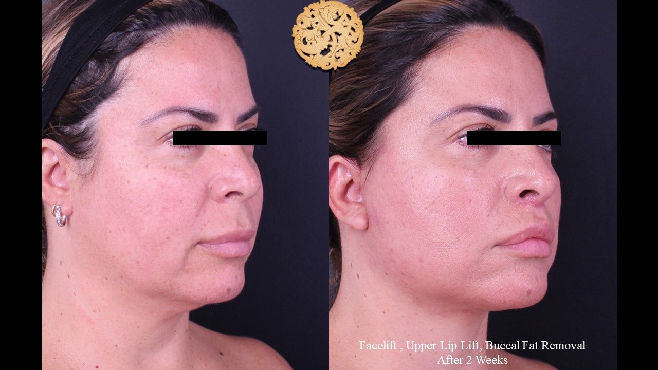 Buccal Fat Removal Before & After