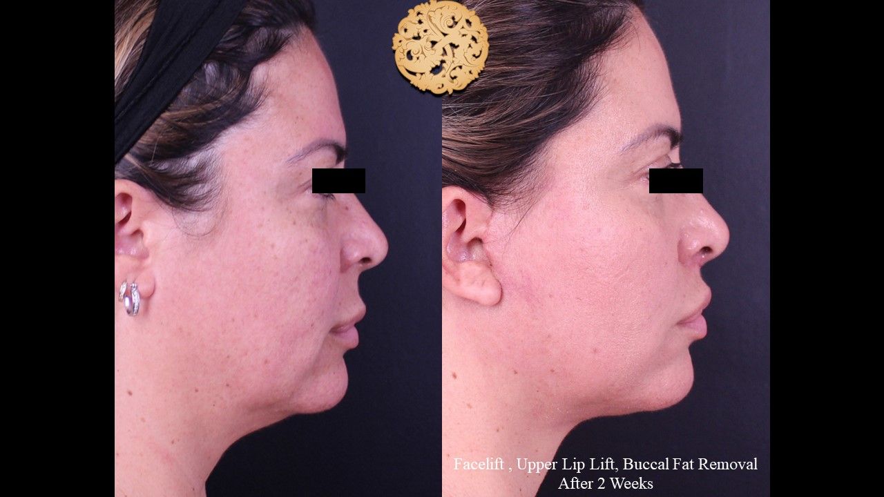 Buccal Fat Removal Before & After